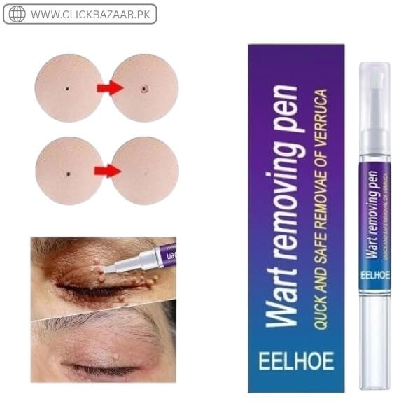 Eelhoe Wart Removing Pen In Pakistan